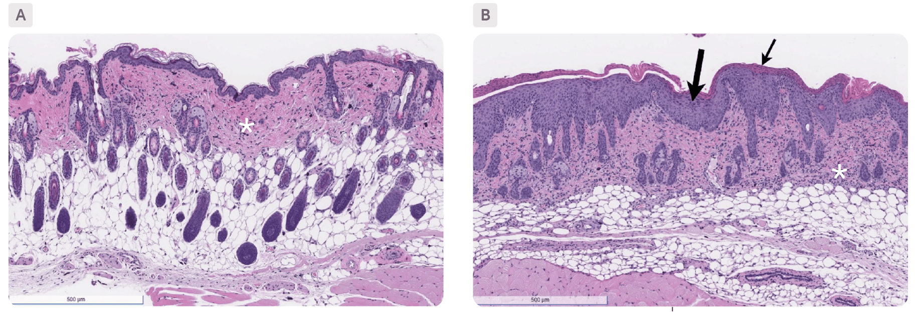 Inflammatory_Skin_Diseases_Webpage_FIGURE_11