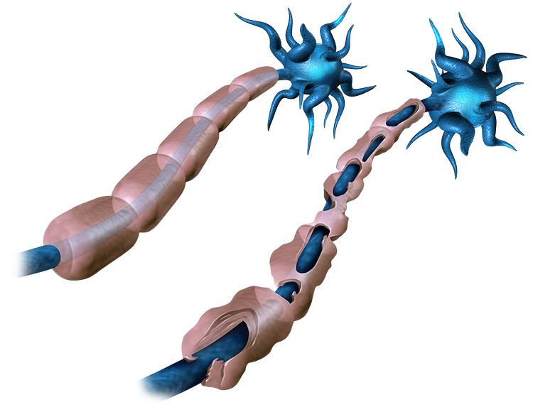 Multiple Sclerosis
